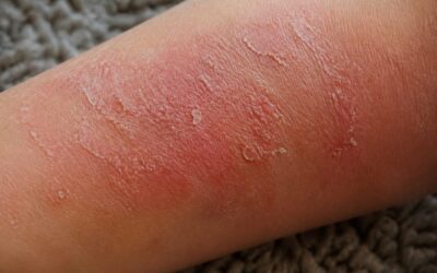 Dermatita atopică și nopțile albe: cum poți gestiona mâncărimea care îți afectează somnul
