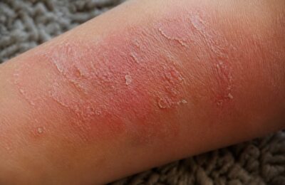Dermatita atopică și nopțile albe: cum poți gestiona mâncărimea care îți afectează somnul