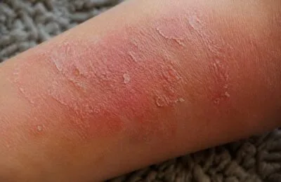 Dermatita atopică și nopțile albe: cum poți gestiona mâncărimea care îți afectează somnul