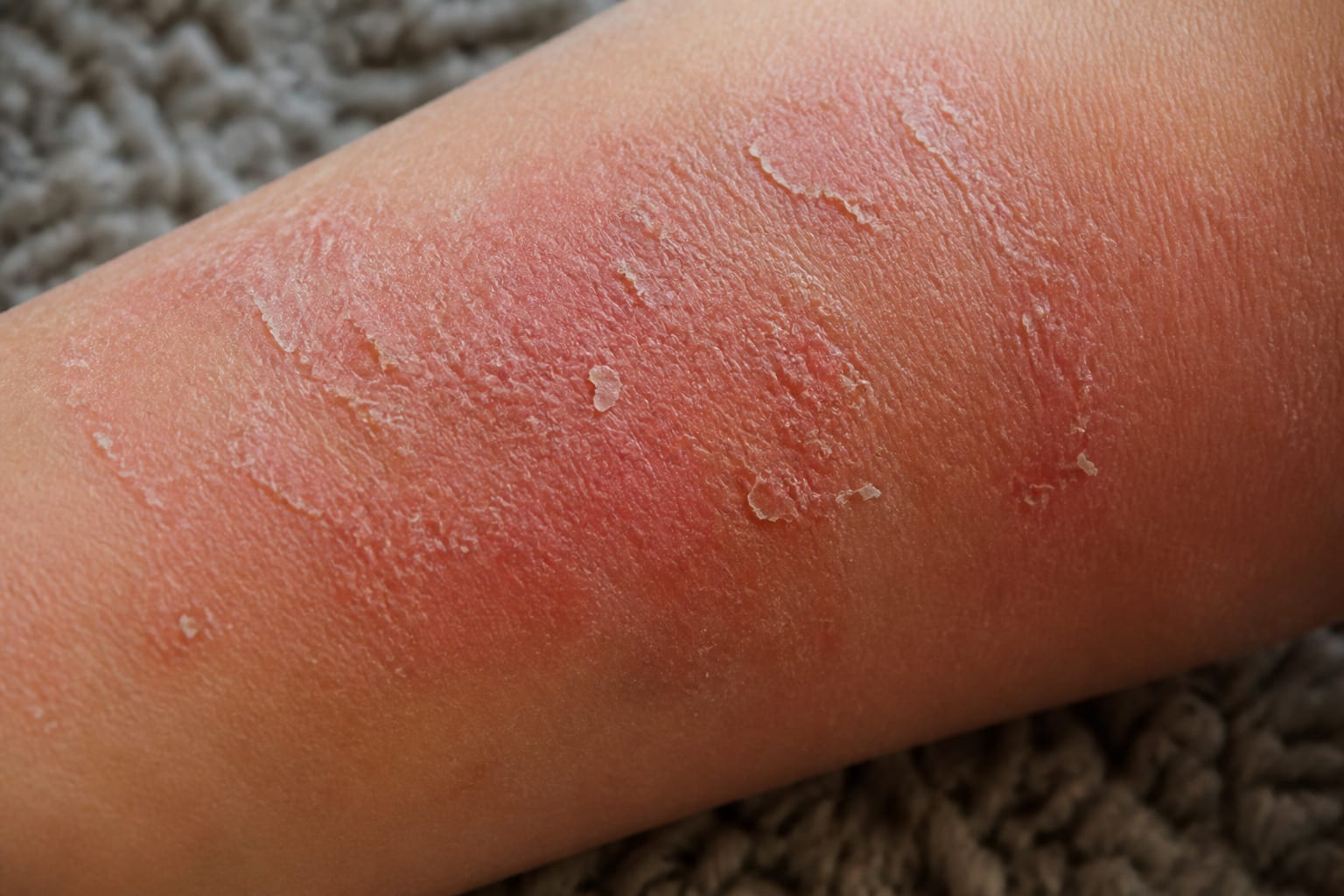 Dermatita atopică și nopțile albe: cum poți gestiona mâncărimea care îți afectează somnul