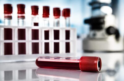 Un nou test de sânge pentru endometrioză a arătat o precizie de peste 95% în studiu